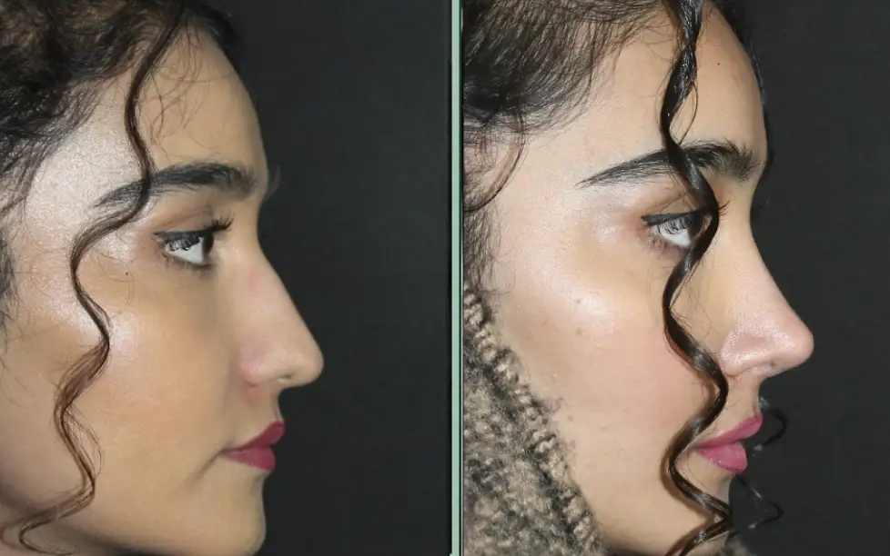 Revision rhinoplasty procedure infographic