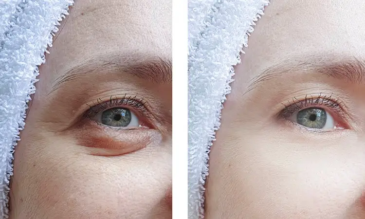 Blepharoplasty cost comparison chart