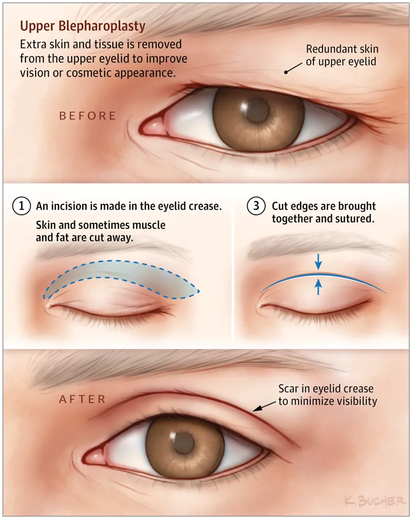 Blepharoplasty surgical procedure
