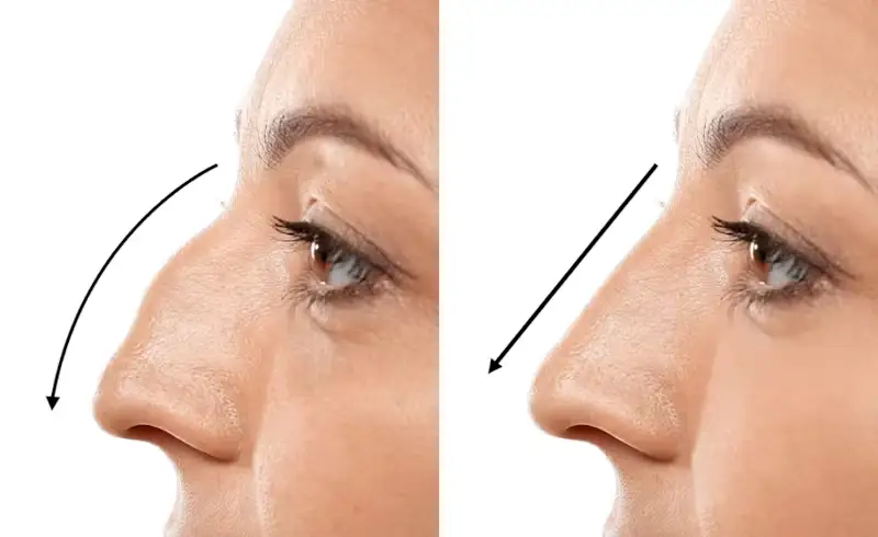Rhinoplasty in Iran