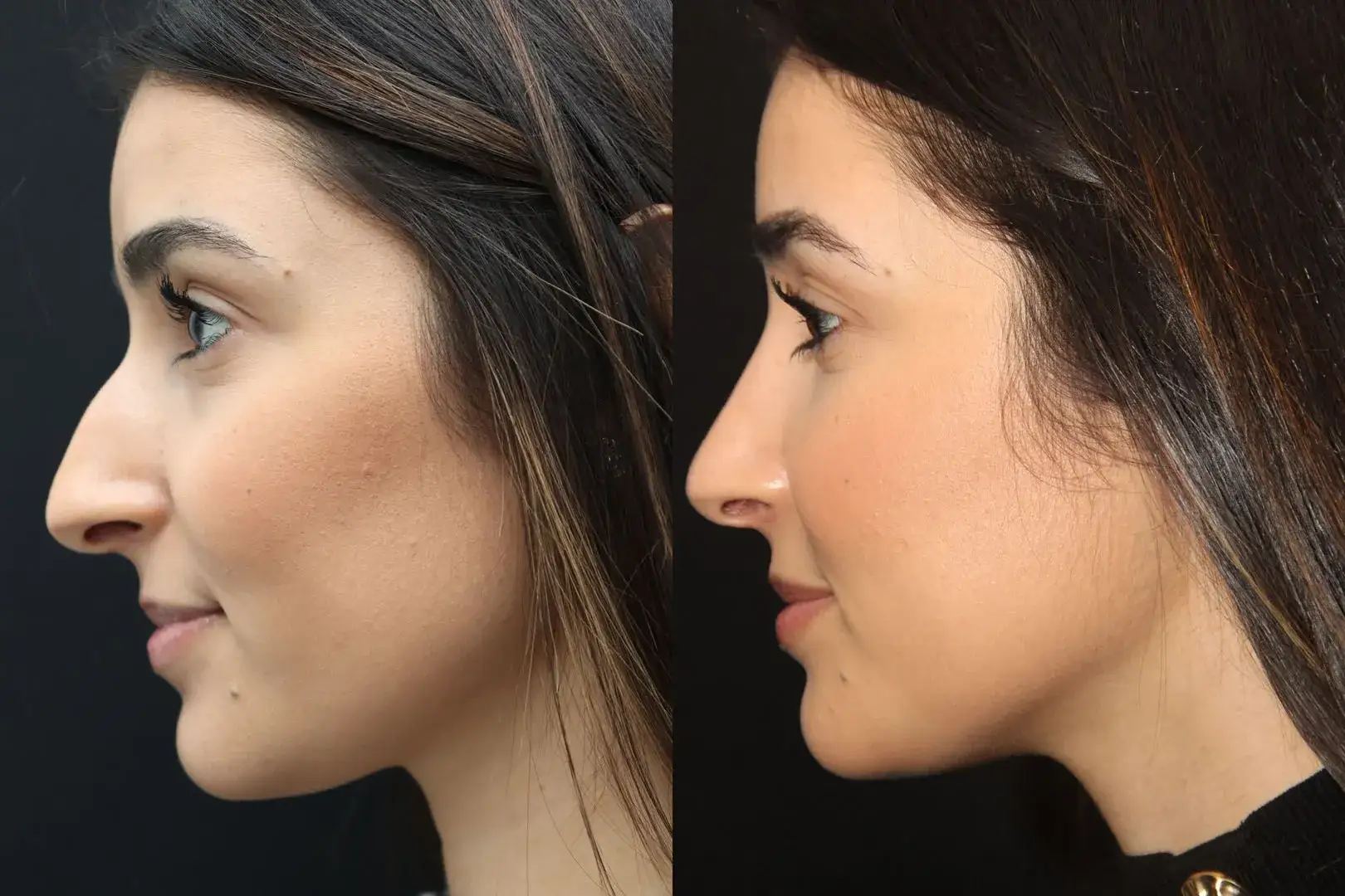 Combined rhinoplasty and blepharoplasty procedure