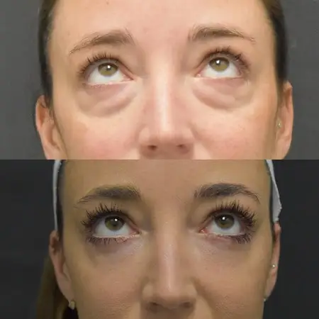 Combined rhinoplasty and blepharoplasty procedure