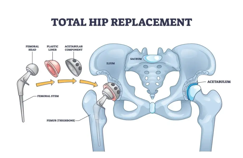Hip Replacement Procedure