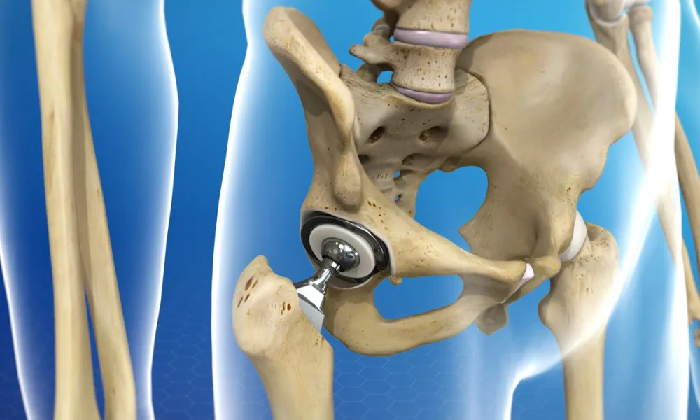 Types of Hip Replacement