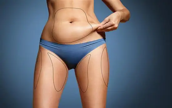 Liposuction Costs in USD