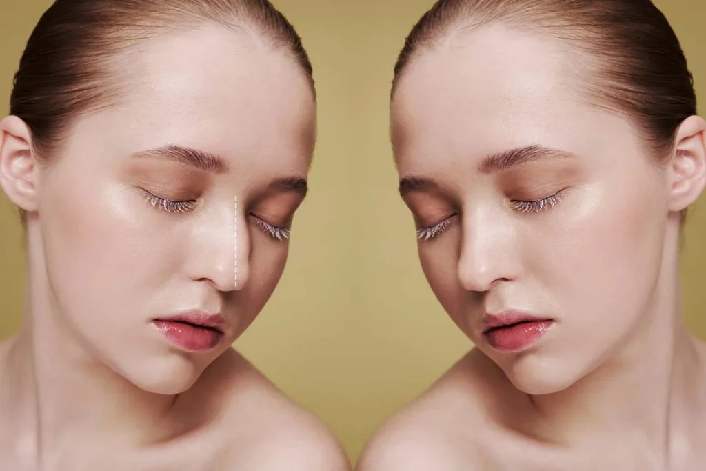 Why Rhinoplasty in Iran