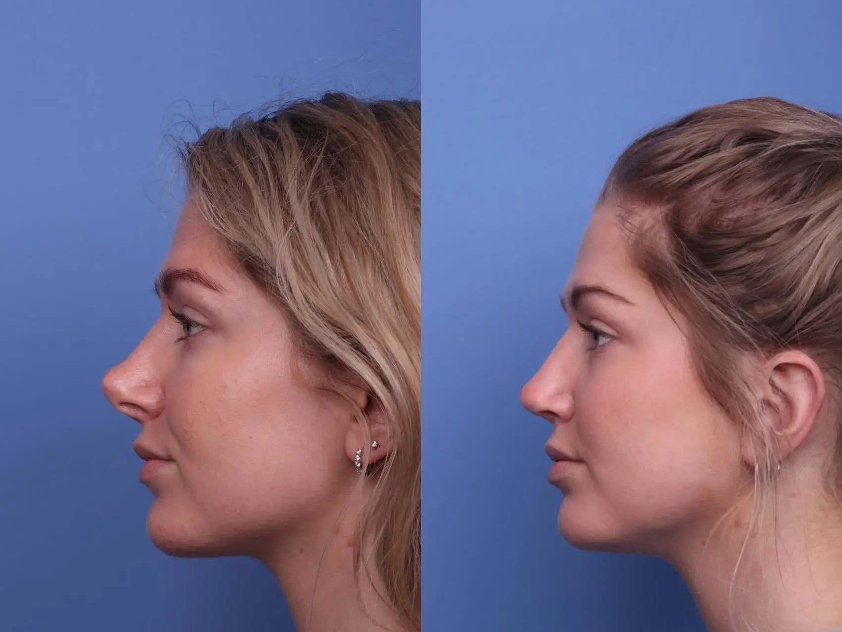 Cost comparison chart for revision rhinoplasty